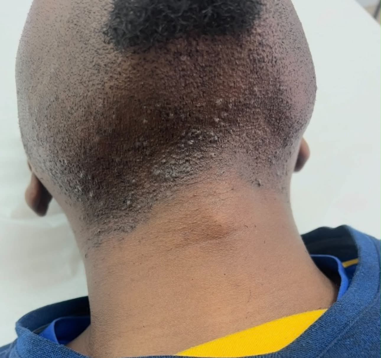 Before photograph provided by Keter Spa, back of neck