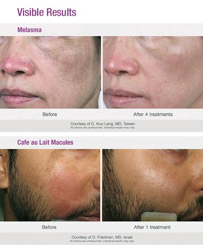 Candela PicoWay Melasma before and after comparison